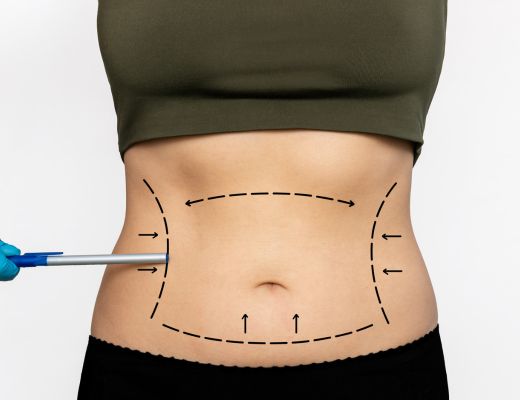 Tummy Tuck